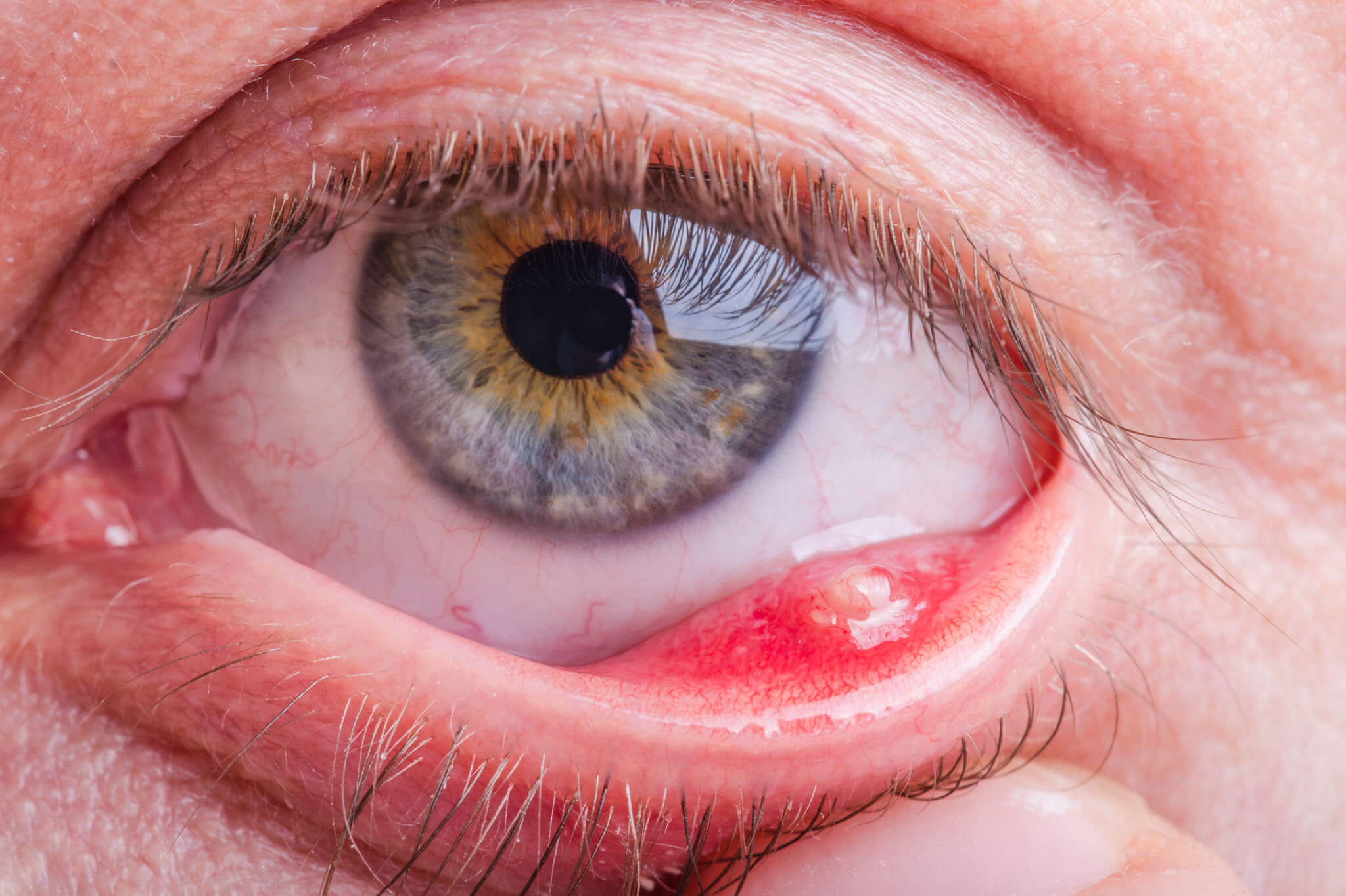 Chalazion Treatment In Miramar , FL | Miramar Eye Institute