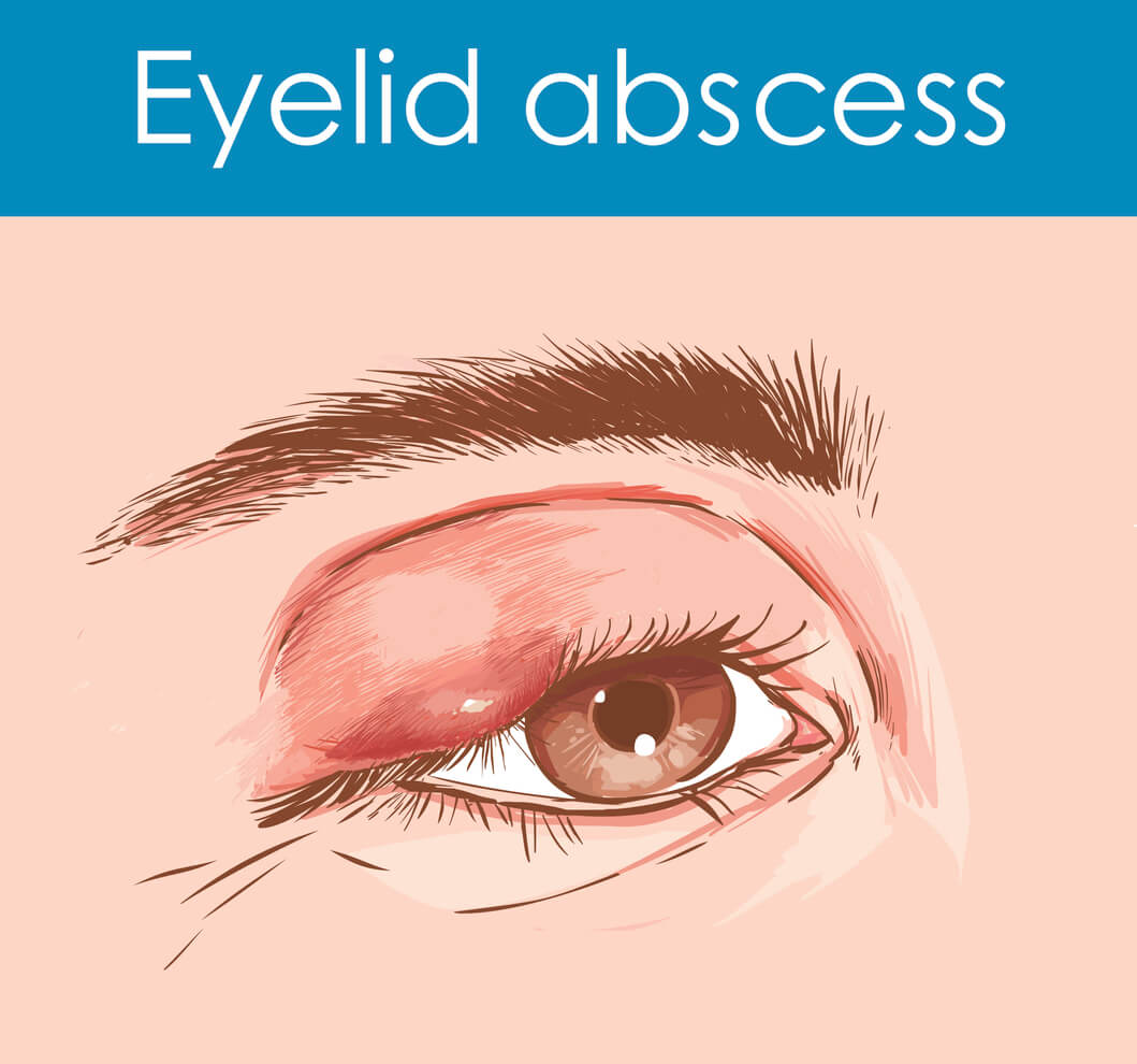 Chalazion Treatment Antibiotic Eye Drops informacionpublica.svet.gob.gt