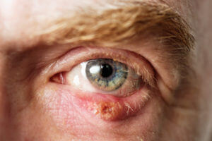Man's infected eye with a chalazion on the lower eyelid